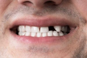 مقایسه هزینه ایمپلنت فوری با ایمپلنت سنتی