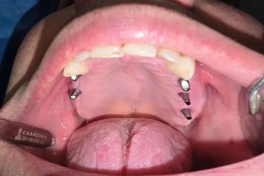 ایمپلنت اقساطی برند مگاژن کره‌ای