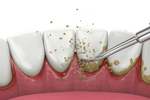 جرم گیری دندان در غرب تهران