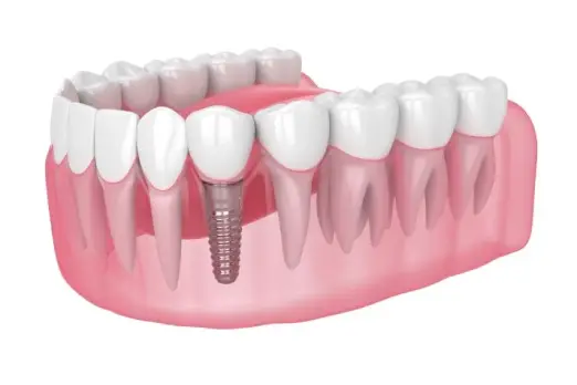 ایمپلنت فوری کل فک پایین در غرب تهران