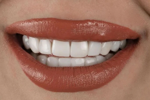 طراحی لبخند با لمینت سرامیکی و کامپوزیتی در غرب تهران