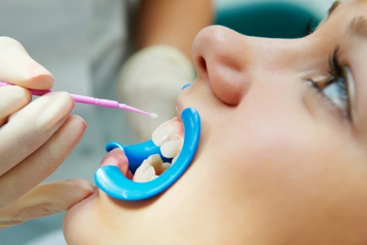 فلوراید تراپی دندان کودکان درغرب تهران